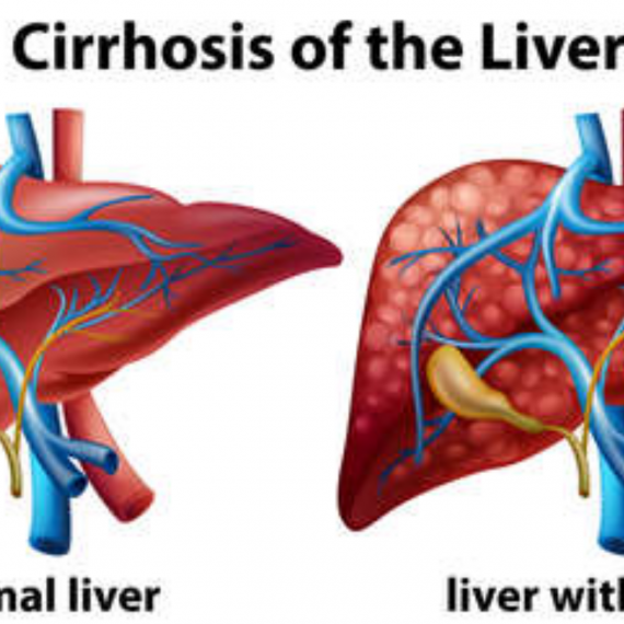 Liver Transplant in India Gives Patients with Advanced Liver Cirrhosis ...