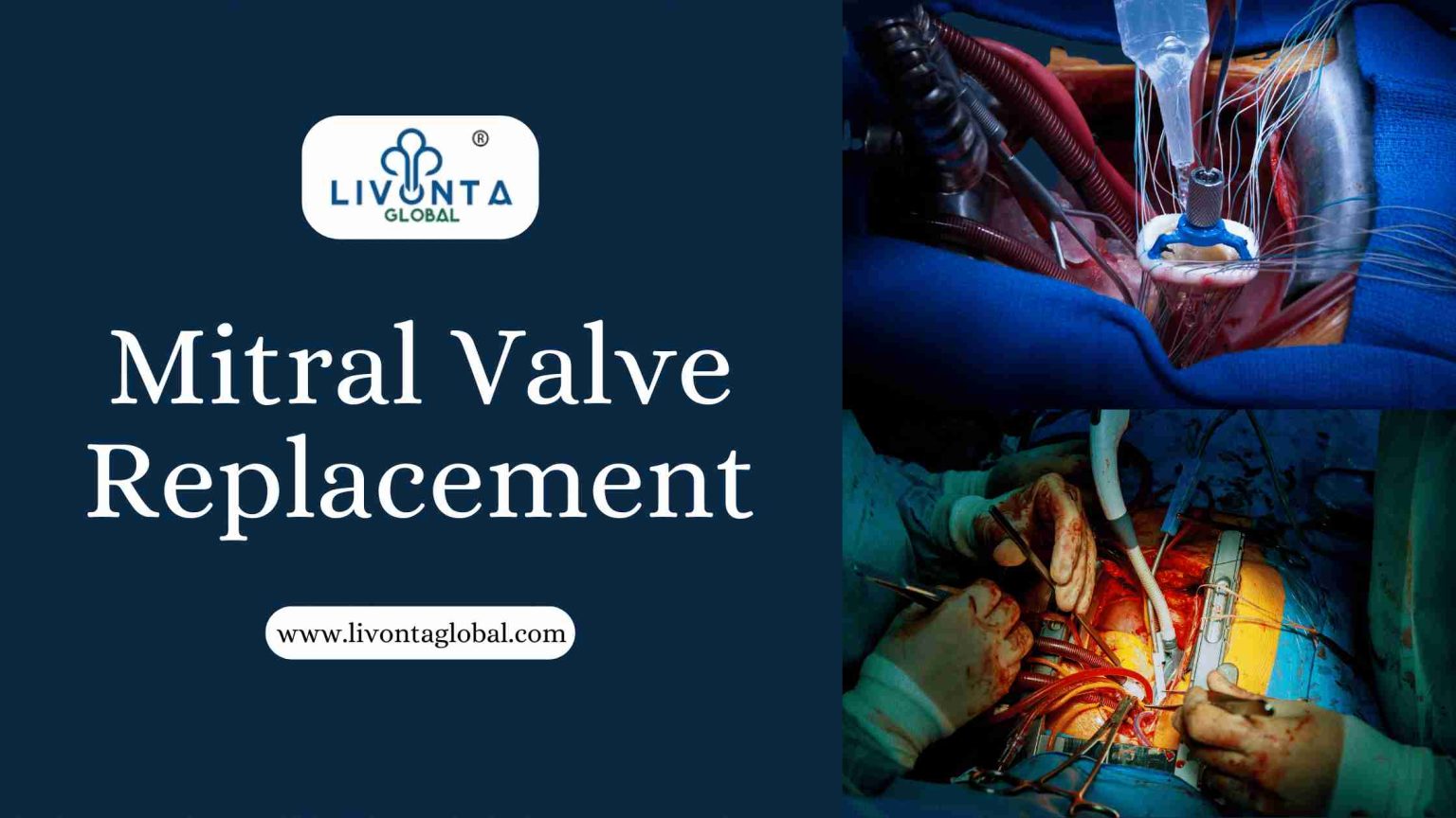 Mitral Valve Replacement - Livonta Global Pvt Ltd